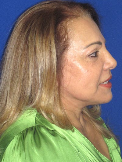 Facelift/Mini-Facelift Before & After Gallery - Patient 328211 - Image 6