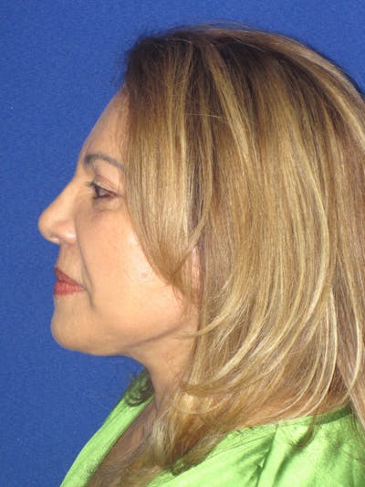Facelift/Mini-Facelift Before & After Gallery - Patient 328211 - Image 10