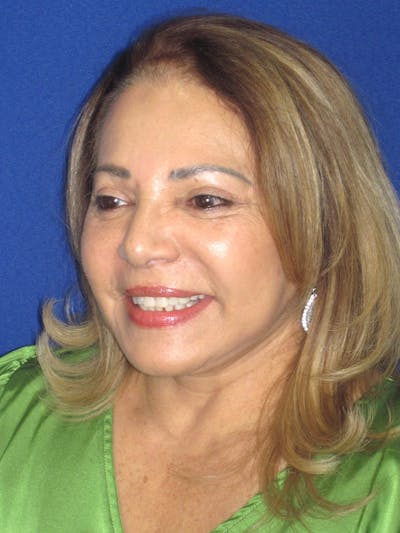 Facelift/Mini-Facelift Before & After Gallery - Patient 328211 - Image 8