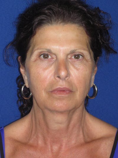 Facelift/Mini-Facelift Before & After Gallery - Patient 187329 - Image 1
