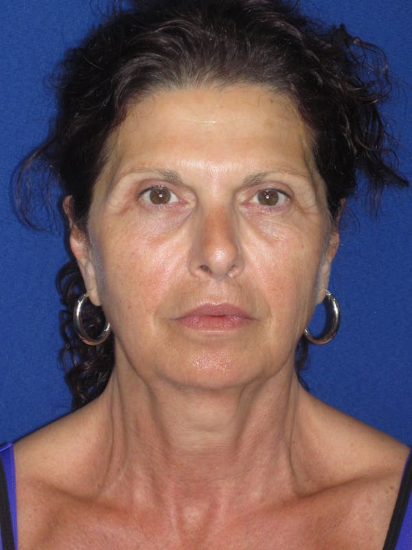 Facelift/Mini-Facelift Before & After Gallery - Patient 187329 - Image 1