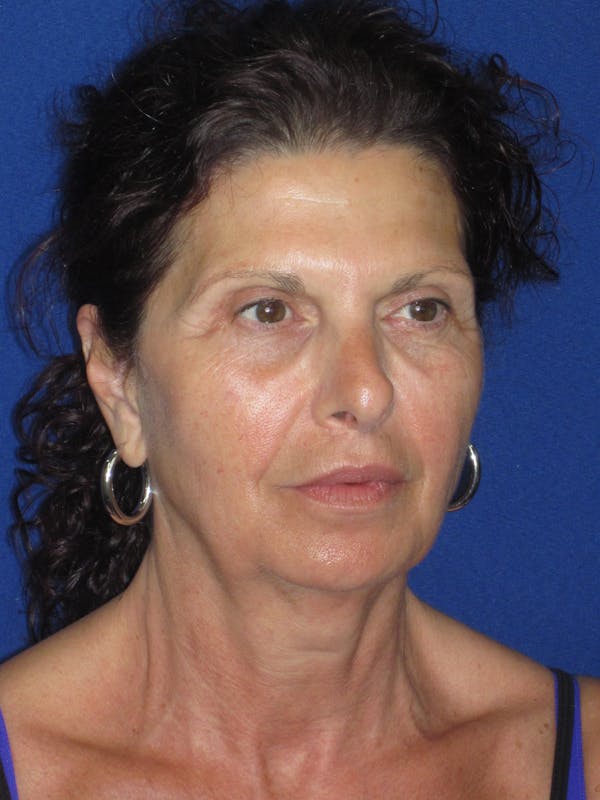 Facelift/Mini-Facelift Before & After Gallery - Patient 187329 - Image 3