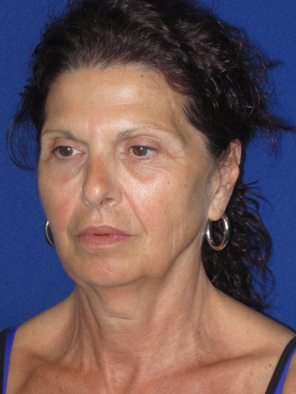 Facelift/Mini-Facelift Before & After Gallery - Patient 187329 - Image 5