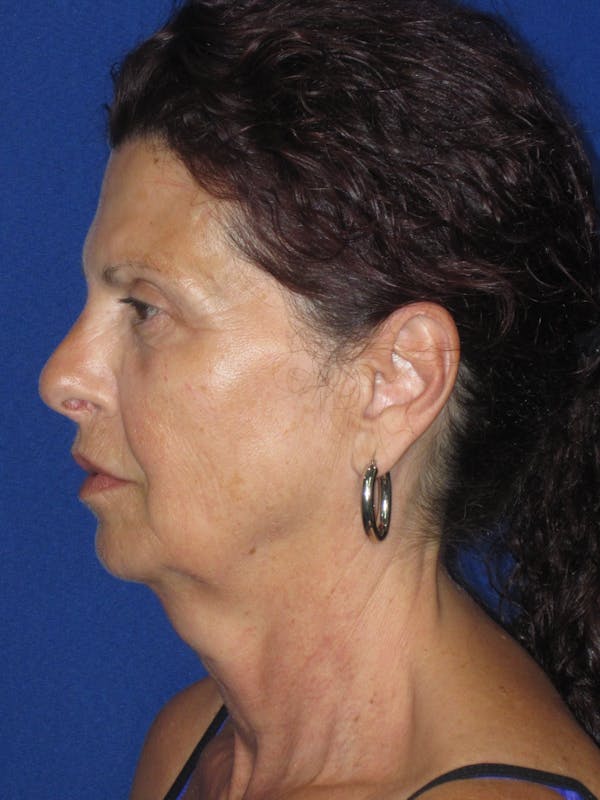 Facelift/Mini-Facelift Before & After Gallery - Patient 187329 - Image 7