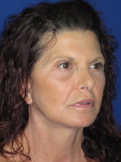 Facelift/Mini-Facelift Before & After Gallery - Patient 187329 - Image 4