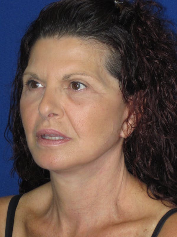 Facelift/Mini-Facelift Before & After Gallery - Patient 187329 - Image 6