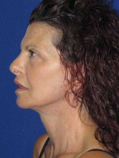 Facelift/Mini-Facelift Before & After Gallery - Patient 187329 - Image 8