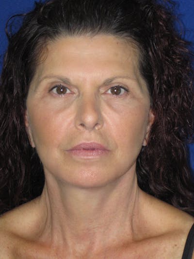 Facelift/Mini-Facelift Before & After Gallery - Patient 187329 - Image 2