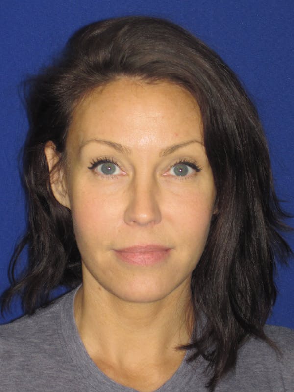 Facelift/Mini-Facelift Before & After Gallery - Patient 654426 - Image 2