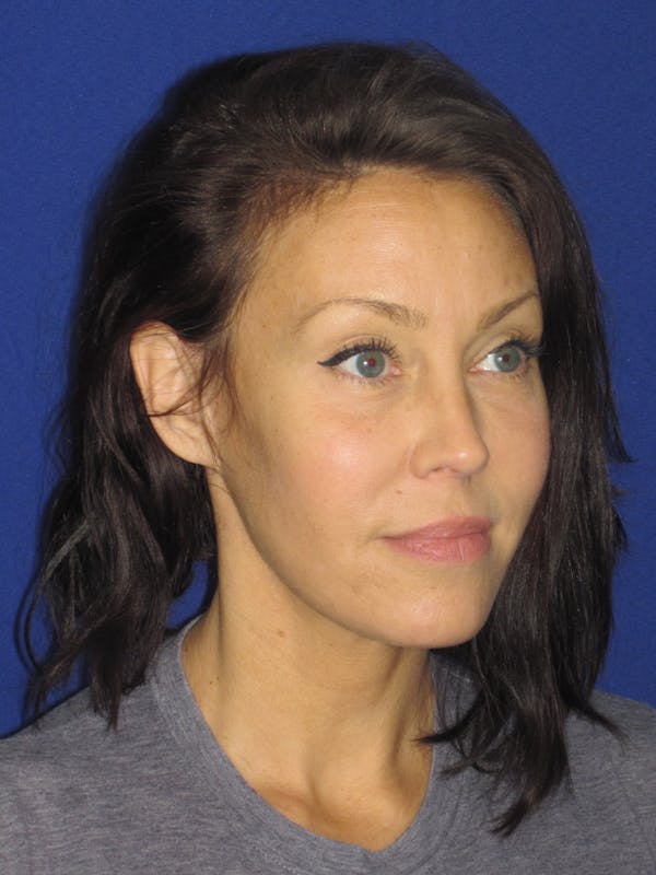 Facelift/Mini-Facelift Before & After Gallery - Patient 654426 - Image 4