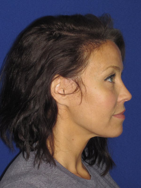 Facelift/Mini-Facelift Before & After Gallery - Patient 654426 - Image 8