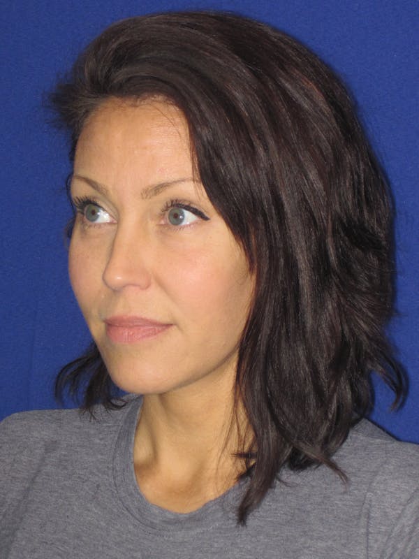 Facelift/Mini-Facelift Before & After Gallery - Patient 654426 - Image 6