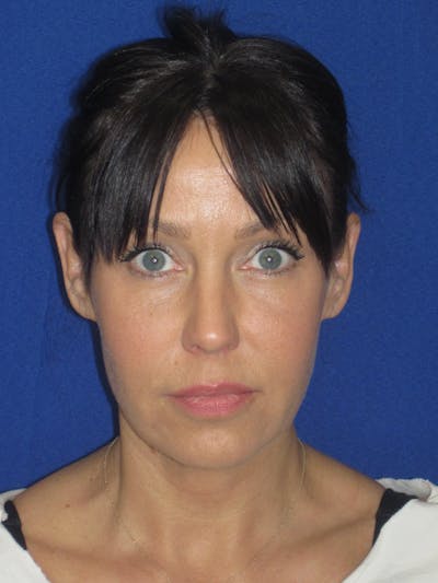 Facelift/Mini-Facelift Before & After Gallery - Patient 654426 - Image 1