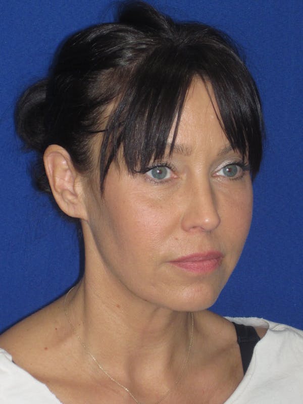 Facelift/Mini-Facelift Before & After Gallery - Patient 654426 - Image 3