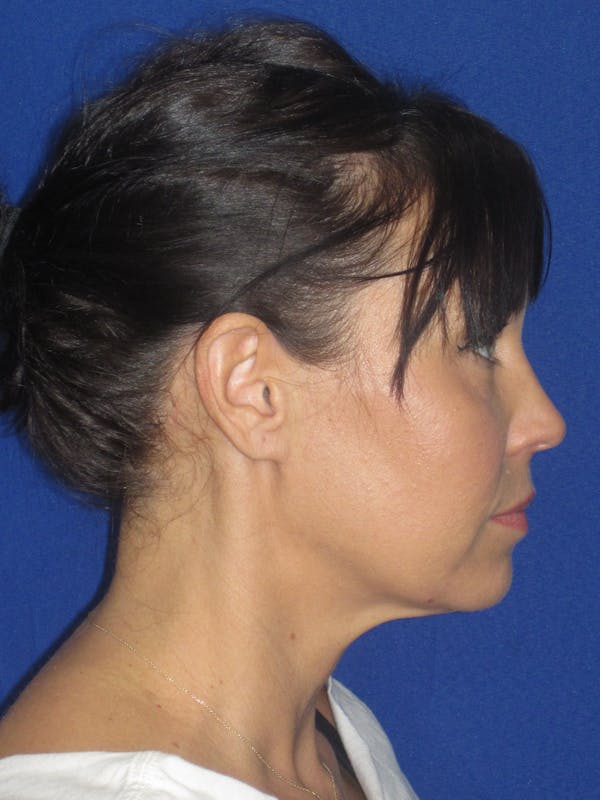 Facelift/Mini-Facelift Before & After Gallery - Patient 654426 - Image 7