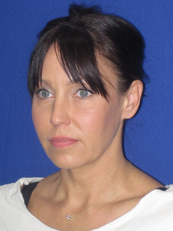 Facelift/Mini-Facelift Before & After Gallery - Patient 654426 - Image 5