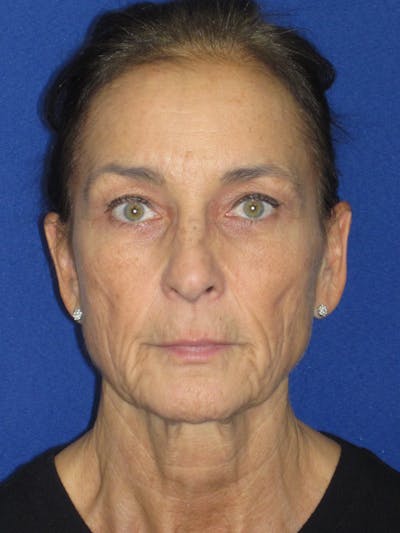 Facelift/Mini-Facelift Before & After Gallery - Patient 194274 - Image 1
