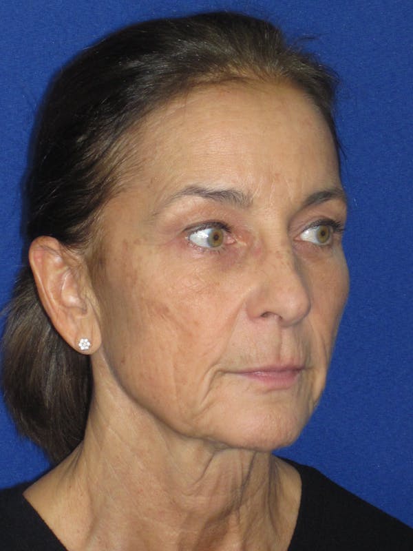 Facelift/Mini-Facelift Before & After Gallery - Patient 194274 - Image 3
