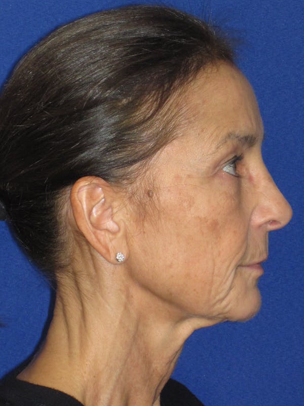 Facelift/Mini-Facelift Before & After Gallery - Patient 194274 - Image 5