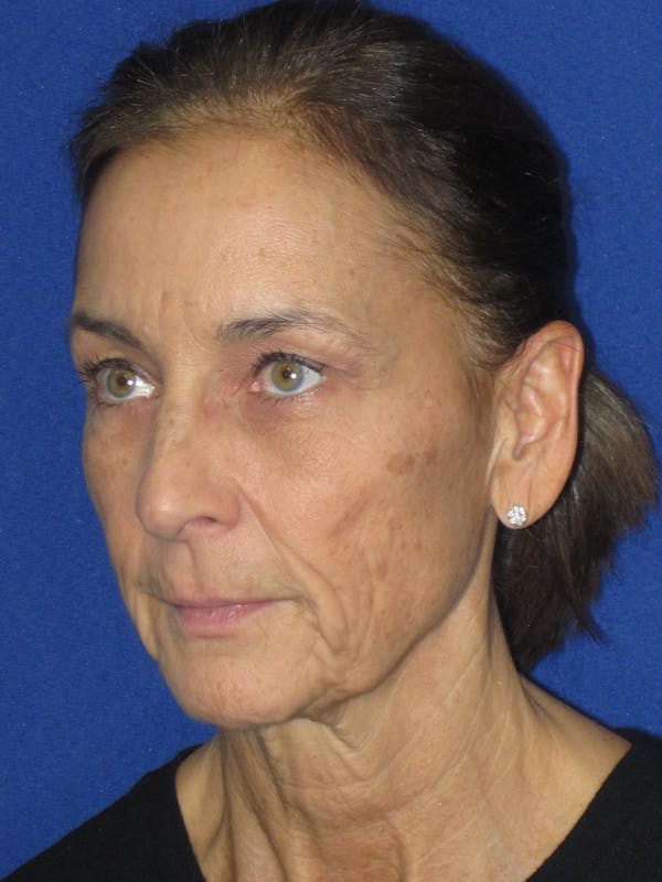Facelift/Mini-Facelift Before & After Gallery - Patient 194274 - Image 7