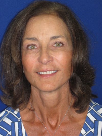 Facelift/Mini-Facelift Before & After Gallery - Patient 194274 - Image 2