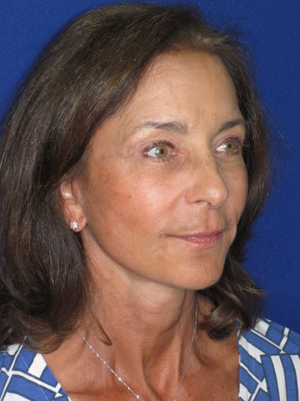 Facelift/Mini-Facelift Before & After Gallery - Patient 194274 - Image 4