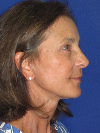 Facelift/Mini-Facelift Before & After Gallery - Patient 194274 - Image 6