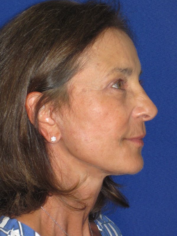 Facelift/Mini-Facelift Before & After Gallery - Patient 194274 - Image 6