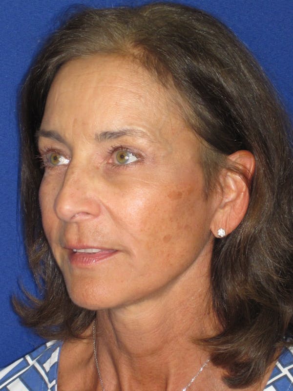 Facelift/Mini-Facelift Before & After Gallery - Patient 194274 - Image 8