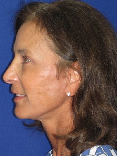 Facelift/Mini-Facelift Before & After Gallery - Patient 194274 - Image 10