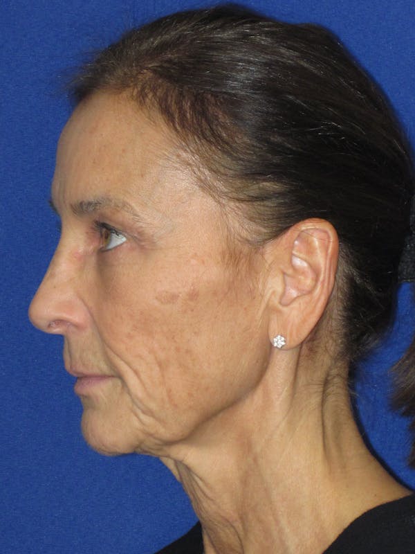 Facelift/Mini-Facelift Before & After Gallery - Patient 194274 - Image 9