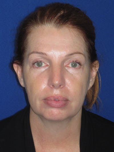 Facelift/Mini-Facelift Before & After Gallery - Patient 257951 - Image 1