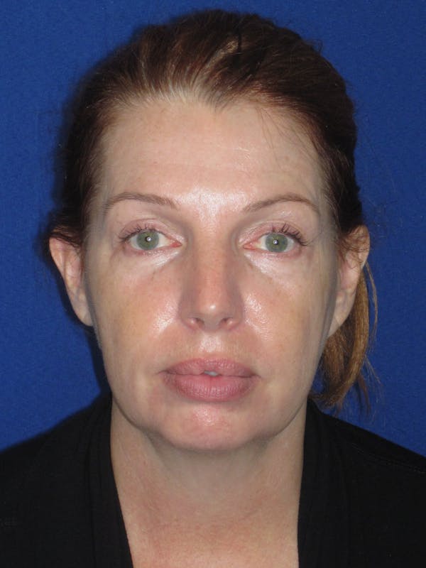 Facelift/Mini-Facelift Before & After Gallery - Patient 257951 - Image 1