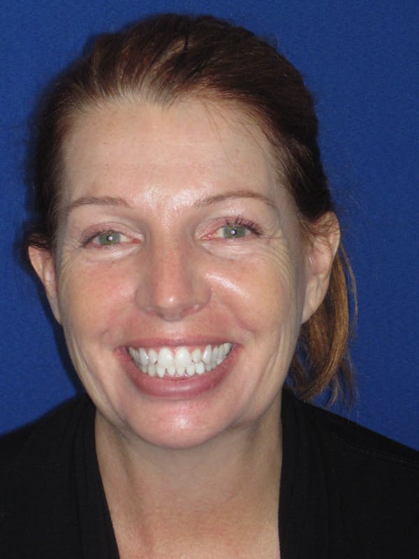 Facelift/Mini-Facelift Before & After Gallery - Patient 257951 - Image 3
