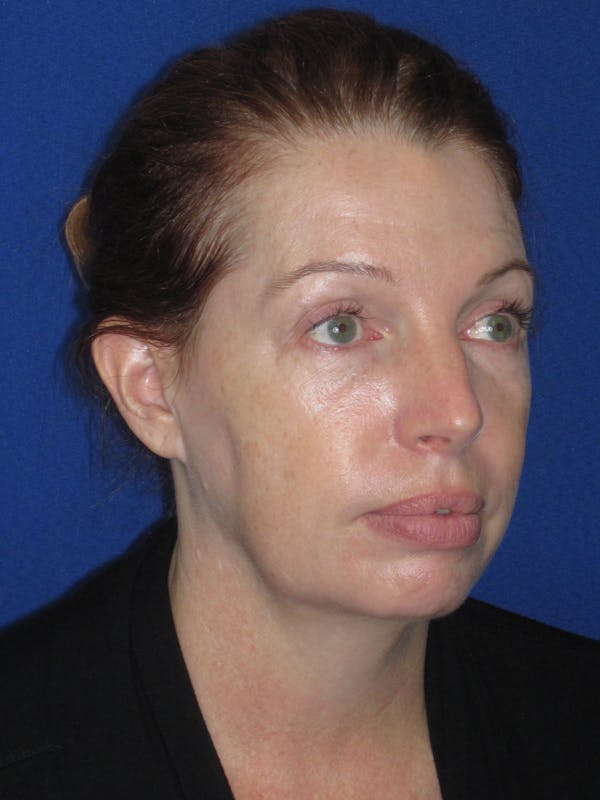 Facelift/Mini-Facelift Before & After Gallery - Patient 257951 - Image 5