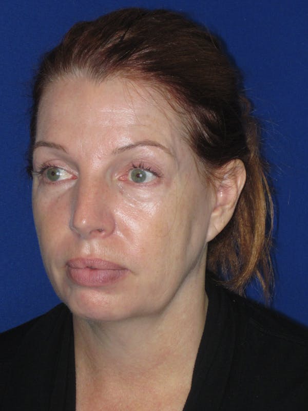 Facelift/Mini-Facelift Before & After Gallery - Patient 257951 - Image 9