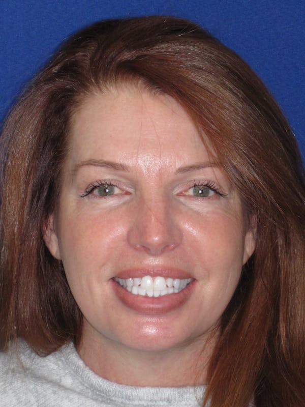 Facelift/Mini-Facelift Before & After Gallery - Patient 257951 - Image 4