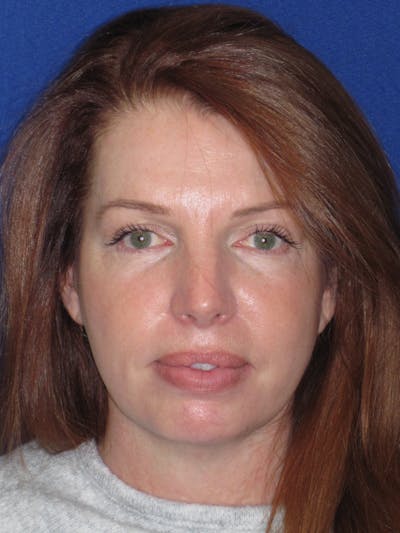 Facelift/Mini-Facelift Before & After Gallery - Patient 257951 - Image 2