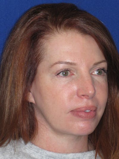 Facelift/Mini-Facelift Before & After Gallery - Patient 257951 - Image 6