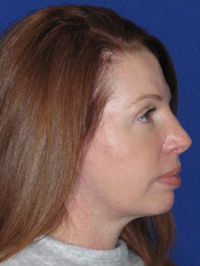 Facelift/Mini-Facelift Before & After Gallery - Patient 257951 - Image 8