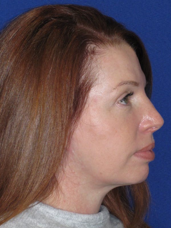 Facelift/Mini-Facelift Before & After Gallery - Patient 257951 - Image 8