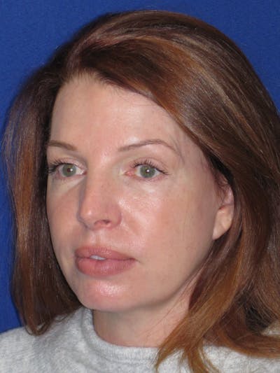 Facelift/Mini-Facelift Before & After Gallery - Patient 257951 - Image 10