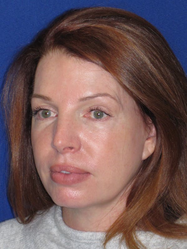 Facelift/Mini-Facelift Before & After Gallery - Patient 257951 - Image 10