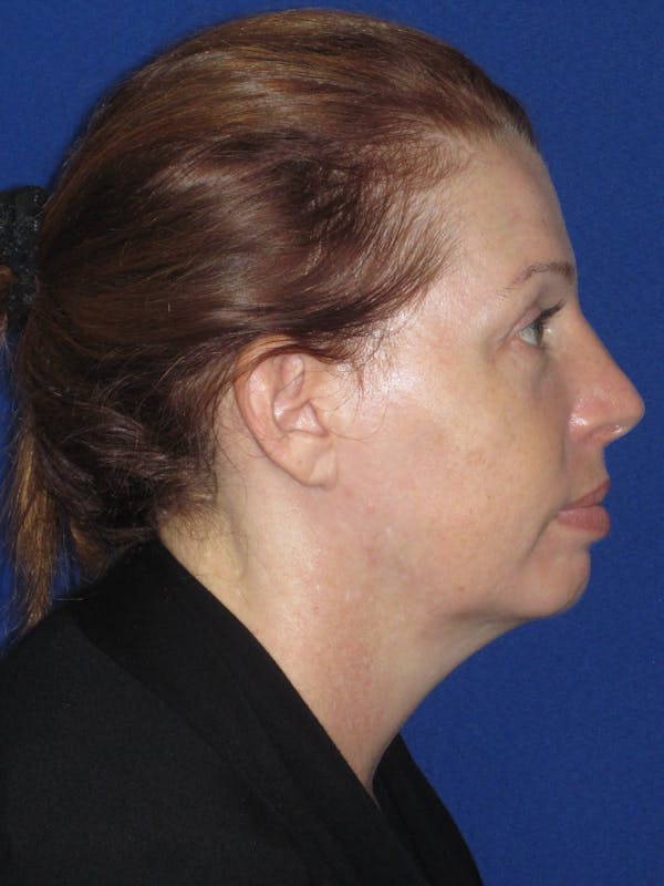 Facelift/Mini-Facelift Before & After Gallery - Patient 257951 - Image 7