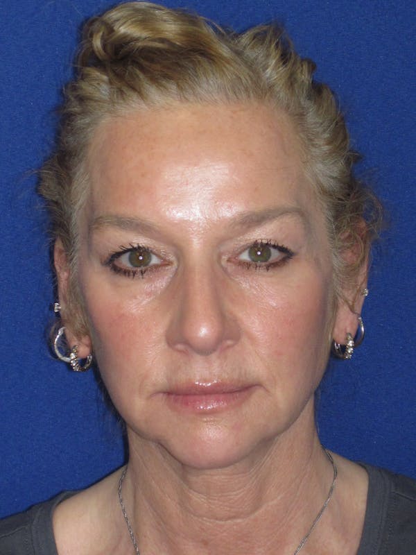 Facelift/Mini-Facelift Before & After Gallery - Patient 254891 - Image 1