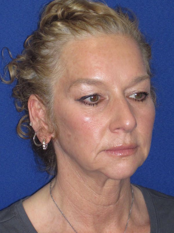 Facelift/Mini-Facelift Before & After Gallery - Patient 254891 - Image 3