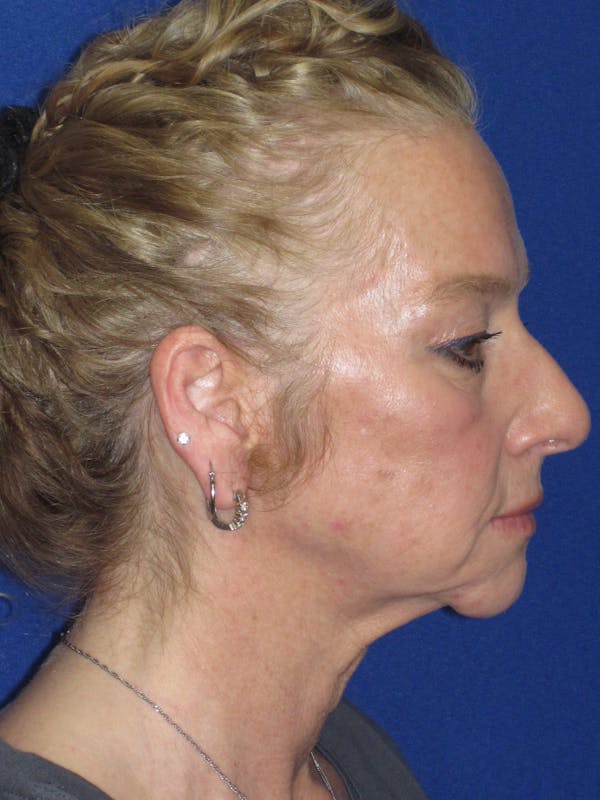 Facelift/Mini-Facelift Before & After Gallery - Patient 254891 - Image 5