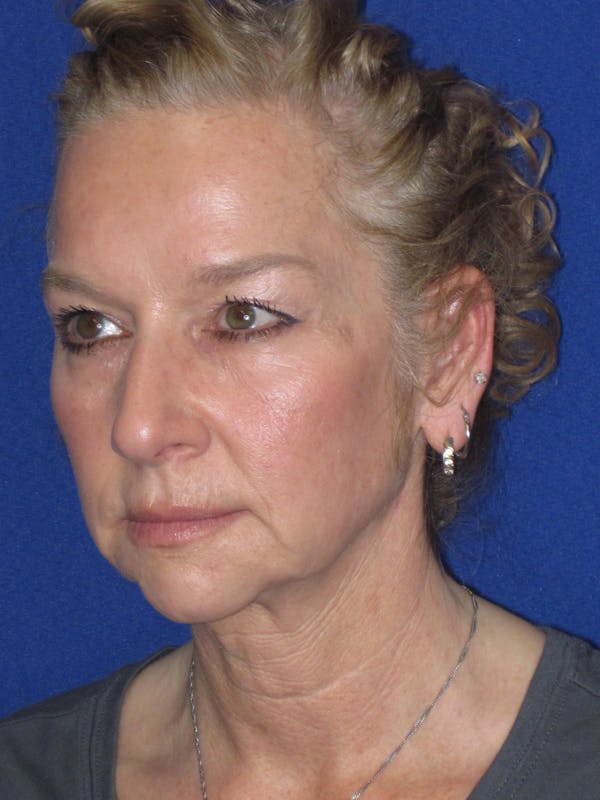 Facelift/Mini-Facelift Before & After Gallery - Patient 254891 - Image 7