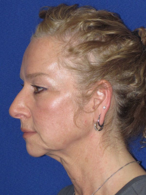 Facelift/Mini-Facelift Before & After Gallery - Patient 254891 - Image 9
