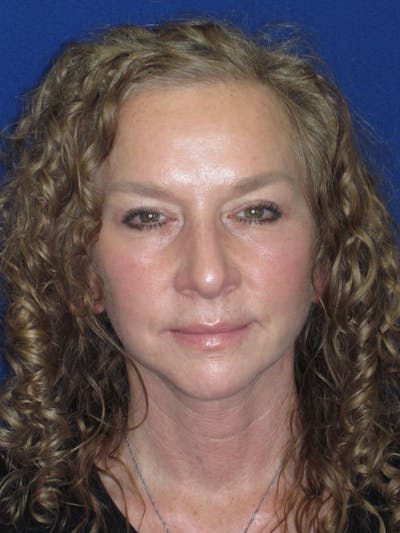 Facelift/Mini-Facelift Before & After Gallery - Patient 254891 - Image 2